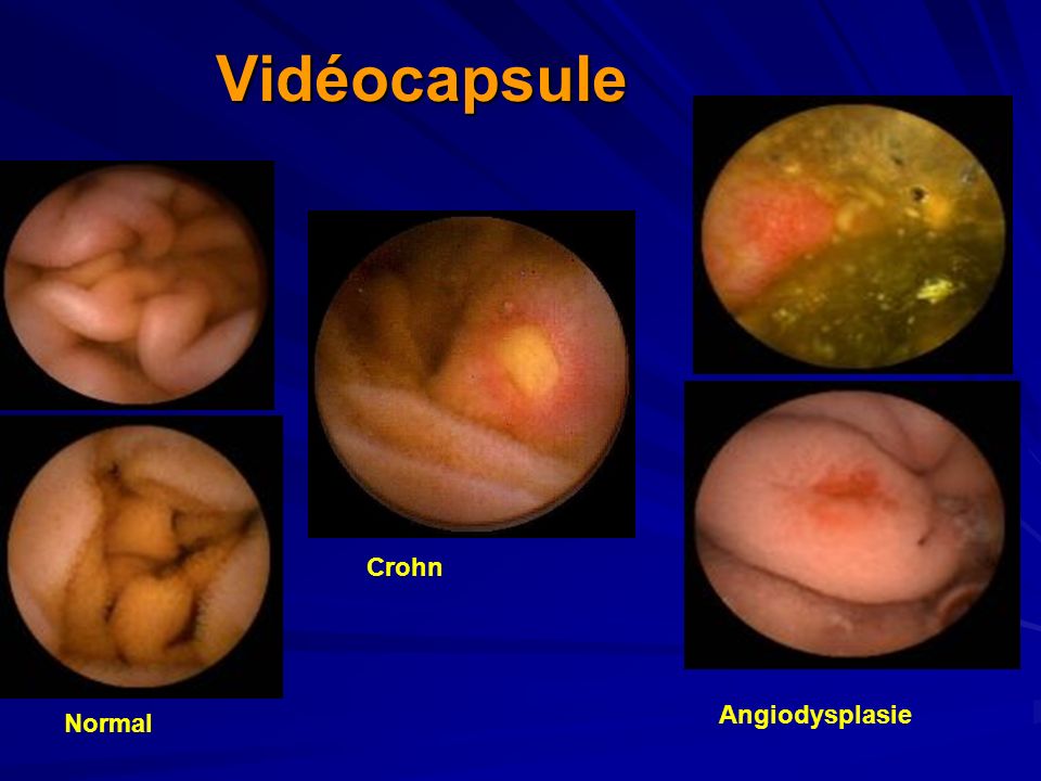 Vidéocapsule Crohn Angiodysplasie Normal