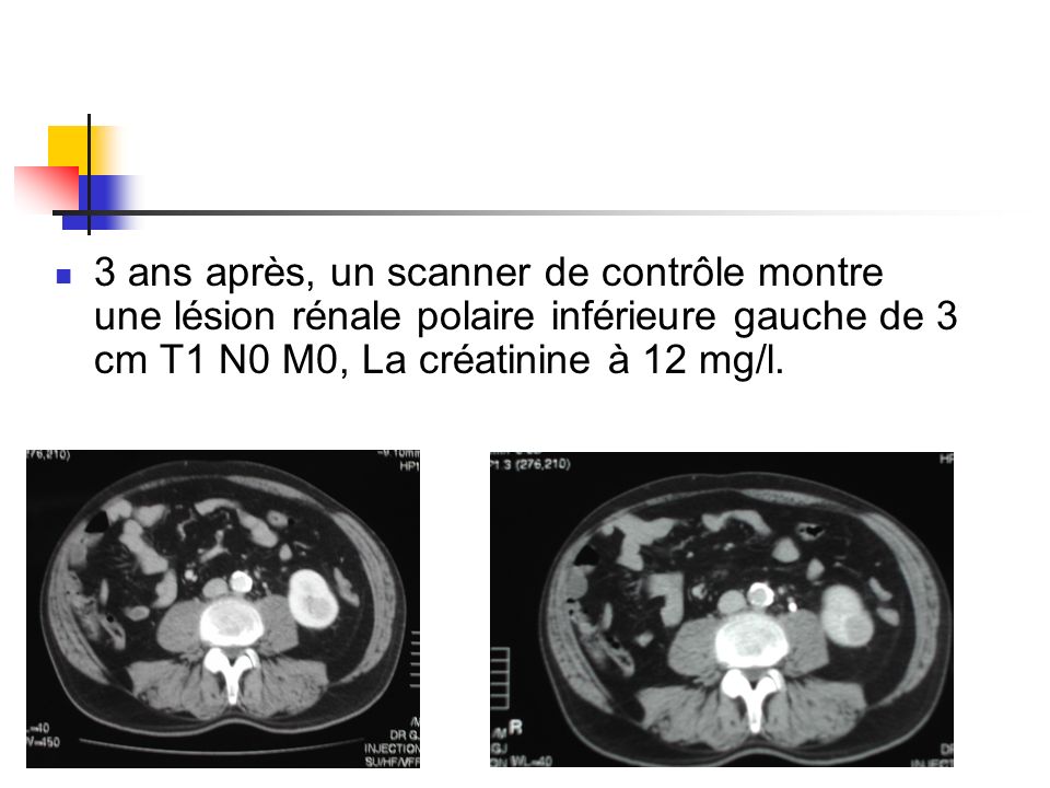 3 ans après, un scanner de contrôle montre une lésion rénale polaire inférieure gauche de 3 cm T1 N0 M0, La créatinine à 12 mg/l.
