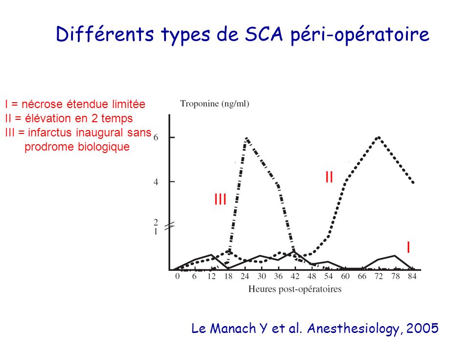 Différents types de SCA péri-opératoire