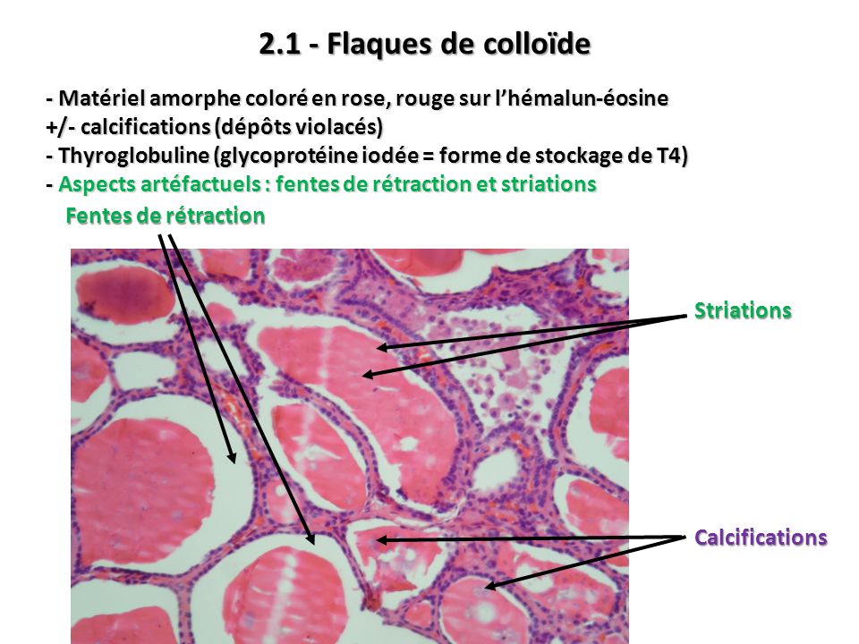 2.1 - Flaques de colloïde - Matériel amorphe coloré en rose, rouge sur l’hémalun-éosine. +/- calcifications (dépôts violacés)