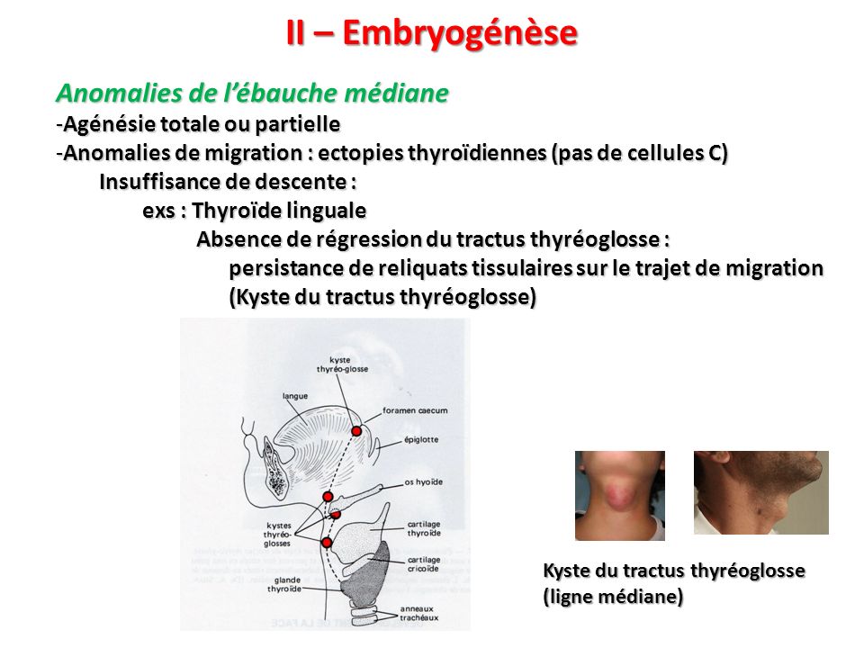 II – Embryogénèse Anomalies de l’ébauche médiane