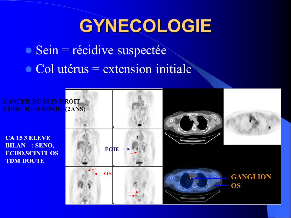 GYNECOLOGIE Sein = récidive suspectée Col utérus = extension initiale