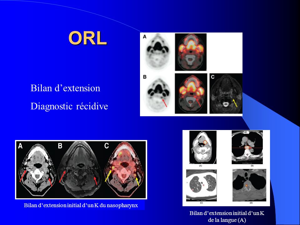 ORL Bilan d’extension Diagnostic récidive