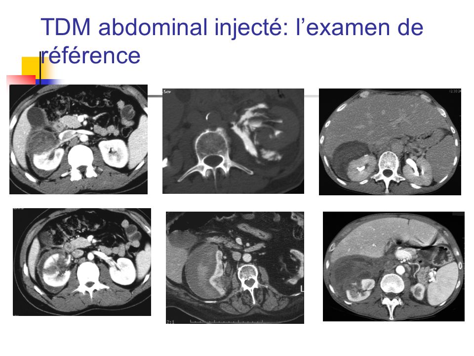 TDM abdominal injecté: l’examen de référence