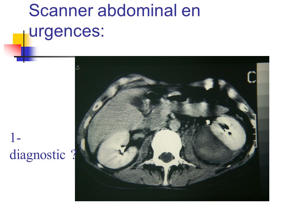 Scanner abdominal en urgences: