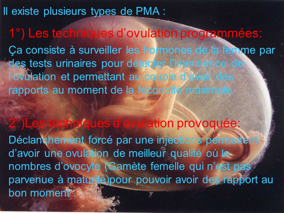 Il existe plusieurs types de PMA :
