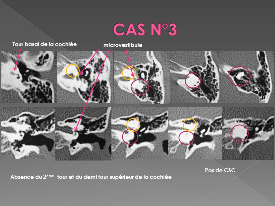 CAS N°3 Tour basal de la cochlée microvestibule Pas de CSC