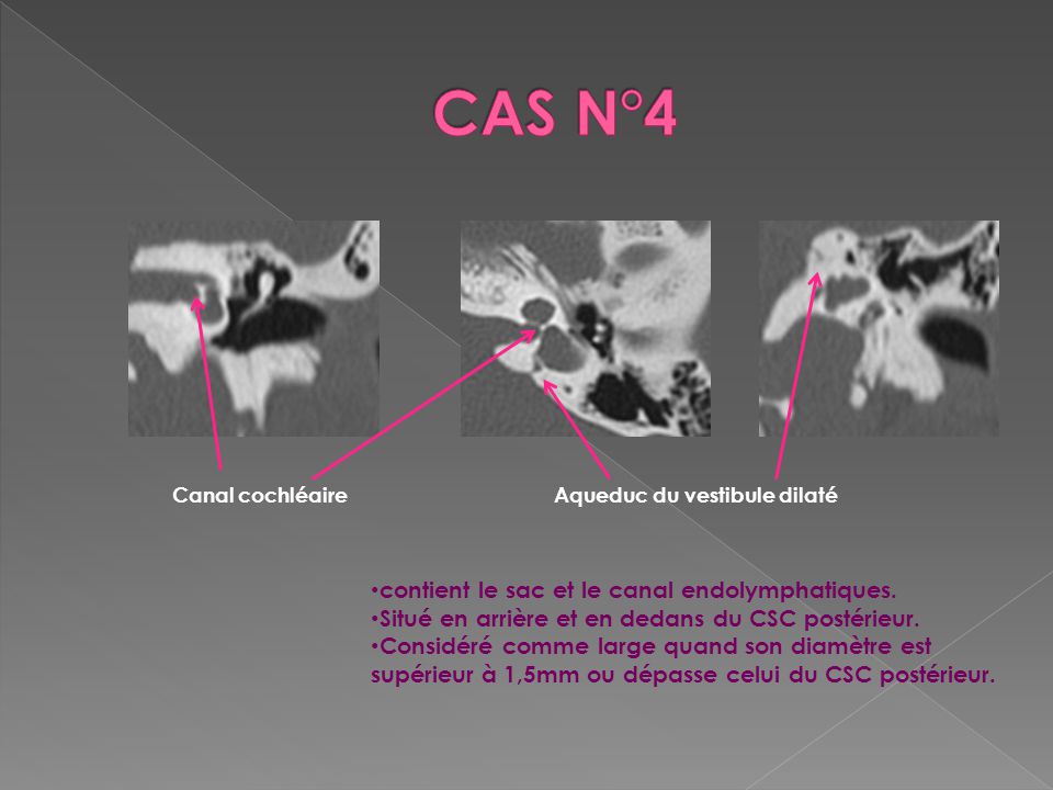 CAS N°4 contient le sac et le canal endolymphatiques.