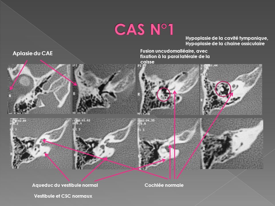 CAS N°1 Hypoplasie de la cavité tympanique, Hypoplasie de la chaine ossiculaire.