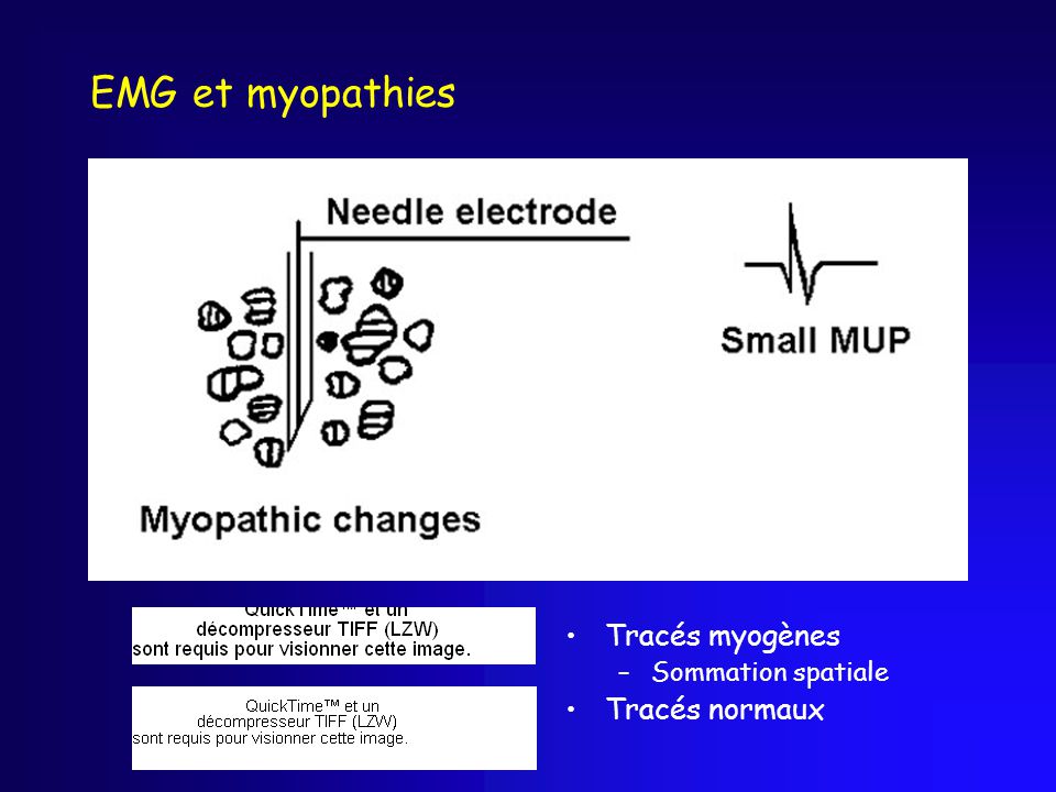 EMG et myopathies Tracés myogènes Sommation spatiale Tracés normaux
