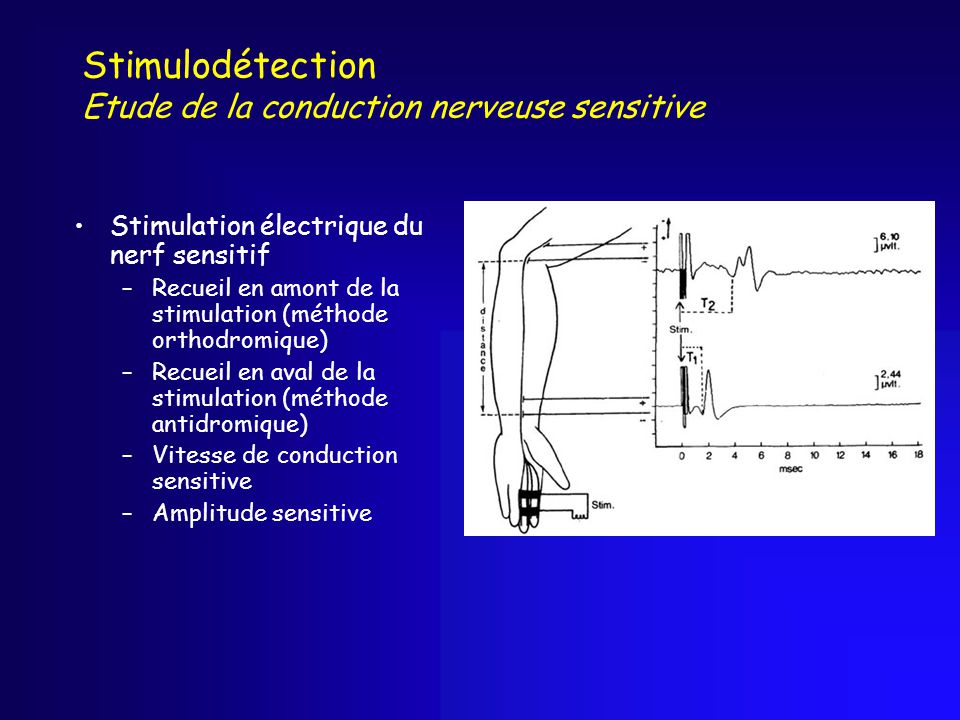Stimulodétection Etude de la conduction nerveuse sensitive