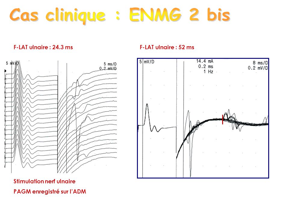 Cas clinique : ENMG 2 bis F-LAT ulnaire : 24.3 ms