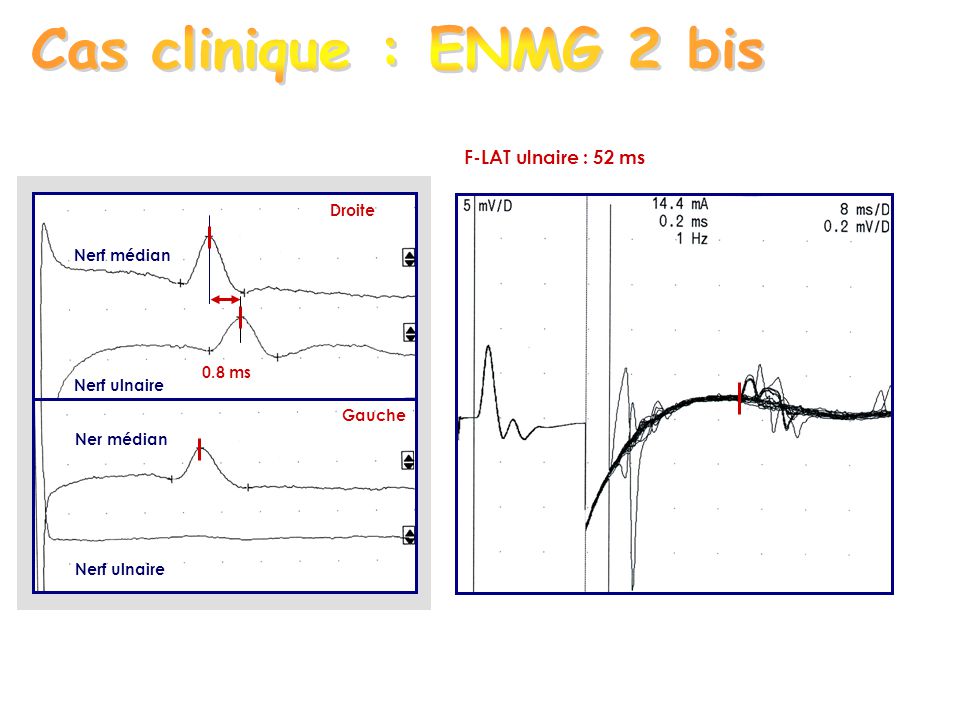Cas clinique : ENMG 2 bis F-LAT ulnaire : 52 ms Droite Nerf médian