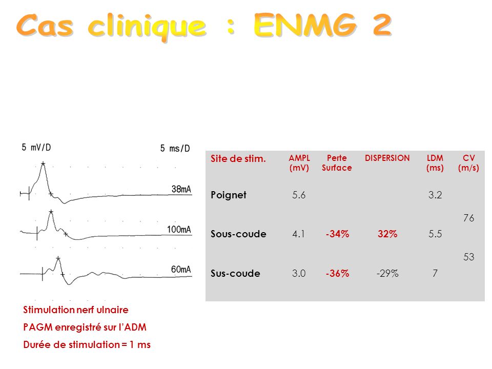 Cas clinique : ENMG 2 Site de stim. Poignet Sous-coude 4.1
