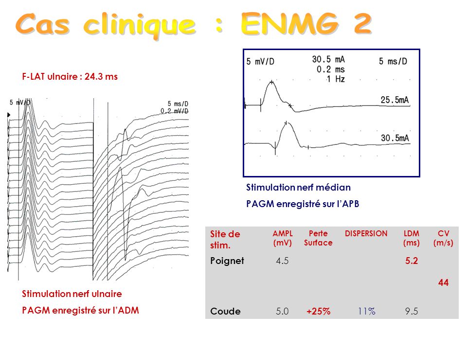 Cas clinique : ENMG 2 Stimulation nerf médian