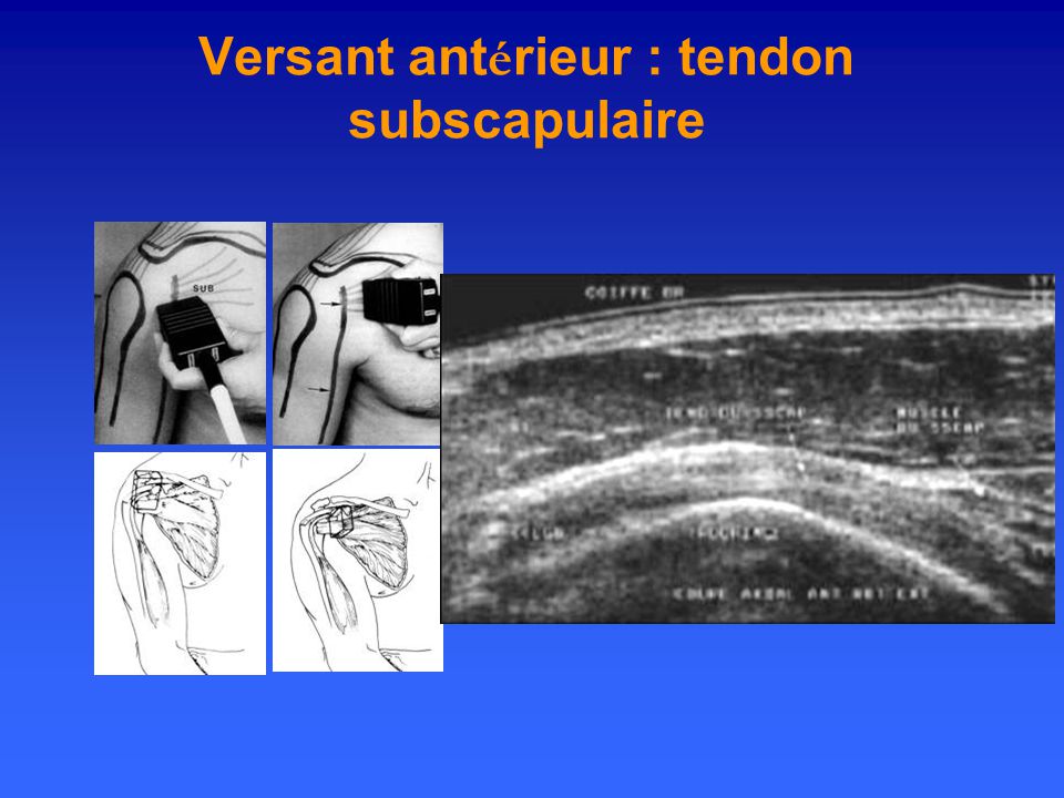 Versant antérieur : tendon subscapulaire