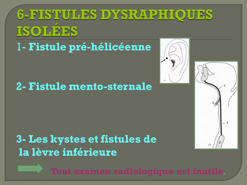 6-FISTULES DYSRAPHIQUES ISOLÉES