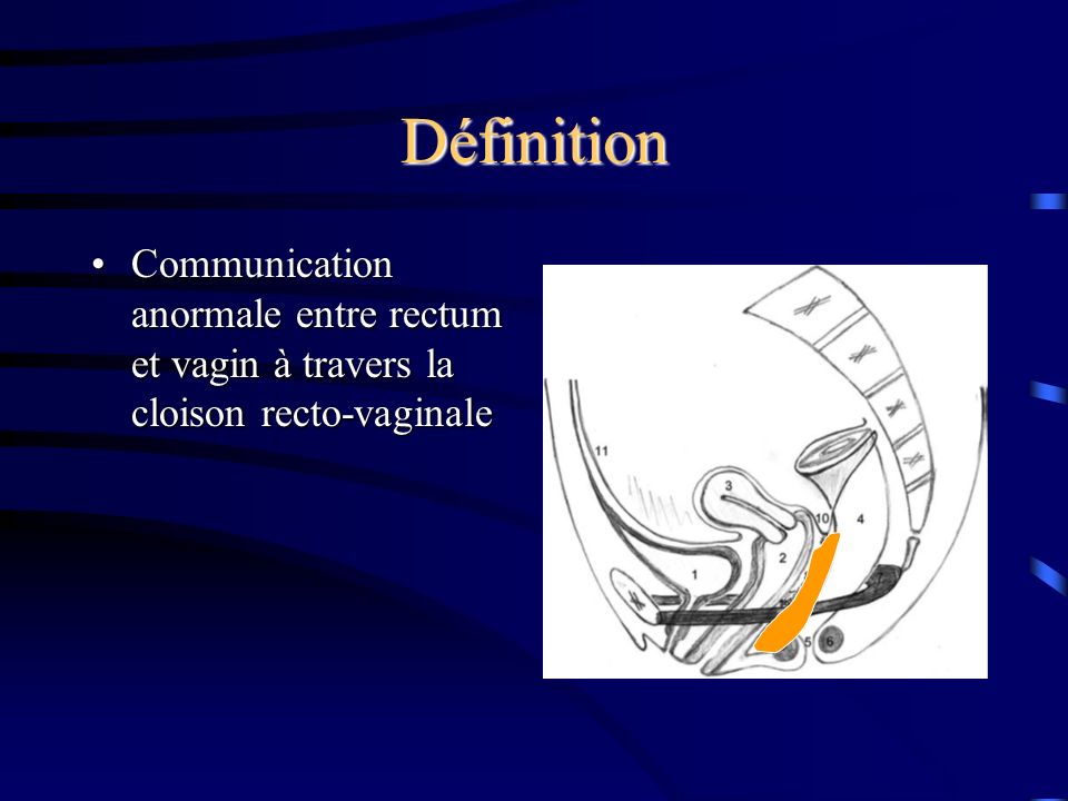 Définition Communication anormale entre rectum et vagin à travers la cloison recto-vaginale