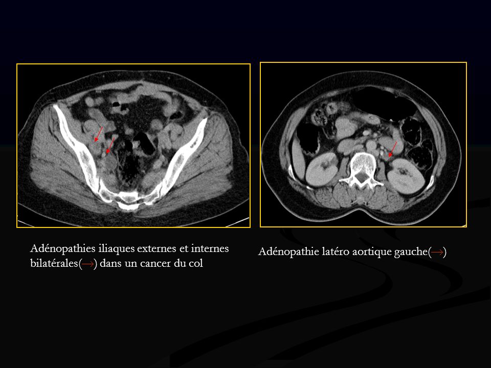 Adénopathies iliaques externes et internes bilatérales() dans un cancer du col