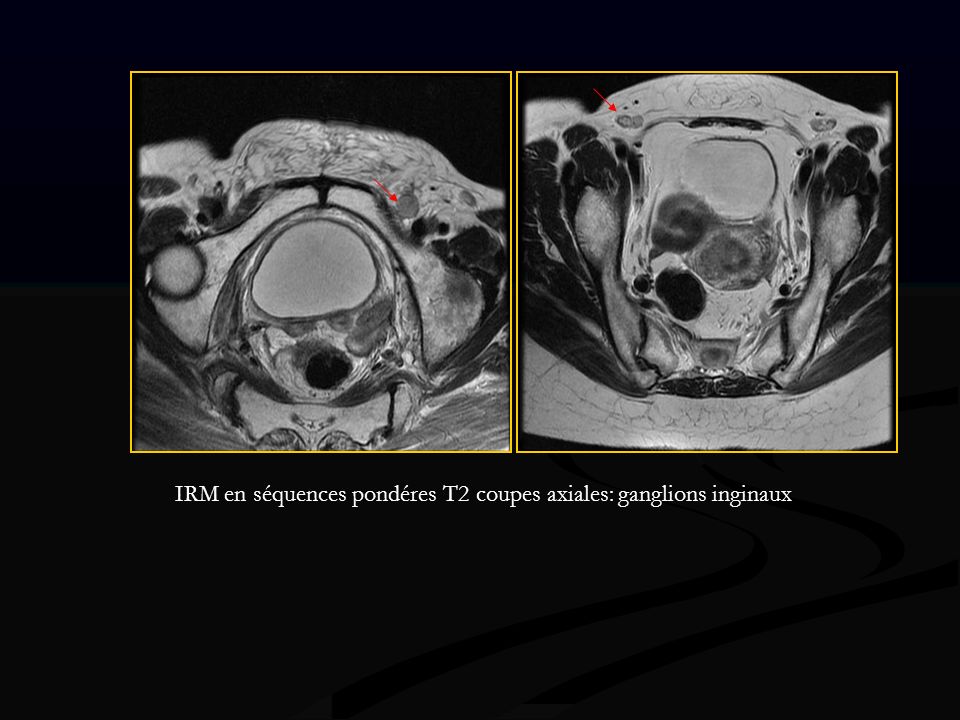 IRM en séquences pondéres T2 coupes axiales: ganglions inginaux