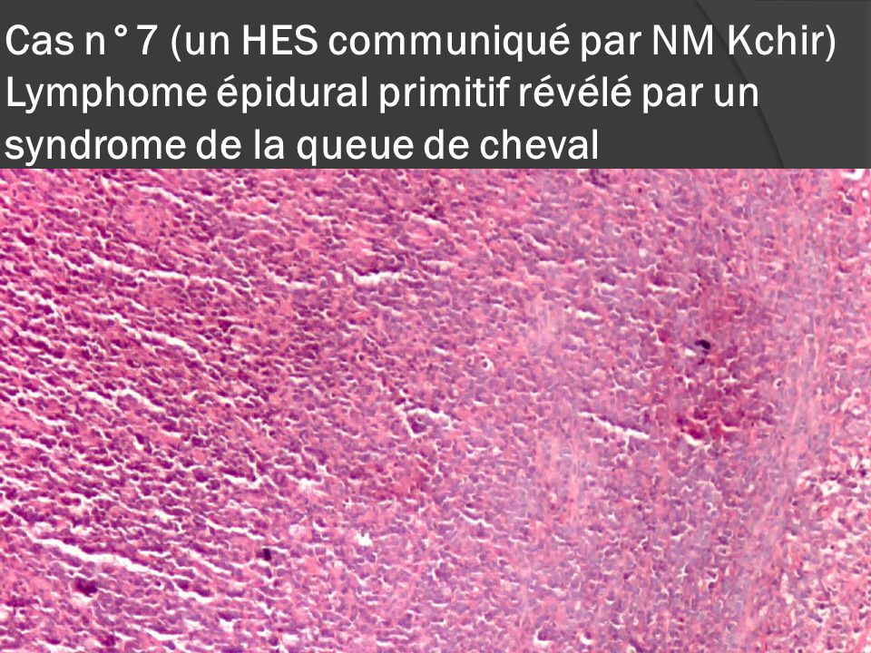 Cas n°7 (un HES communiqué par NM Kchir) Lymphome épidural primitif révélé par un syndrome de la queue de cheval