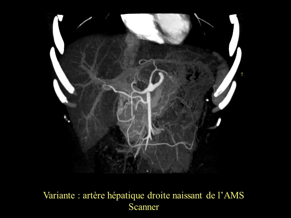 Variante : artère hépatique droite naissant de l’AMS
