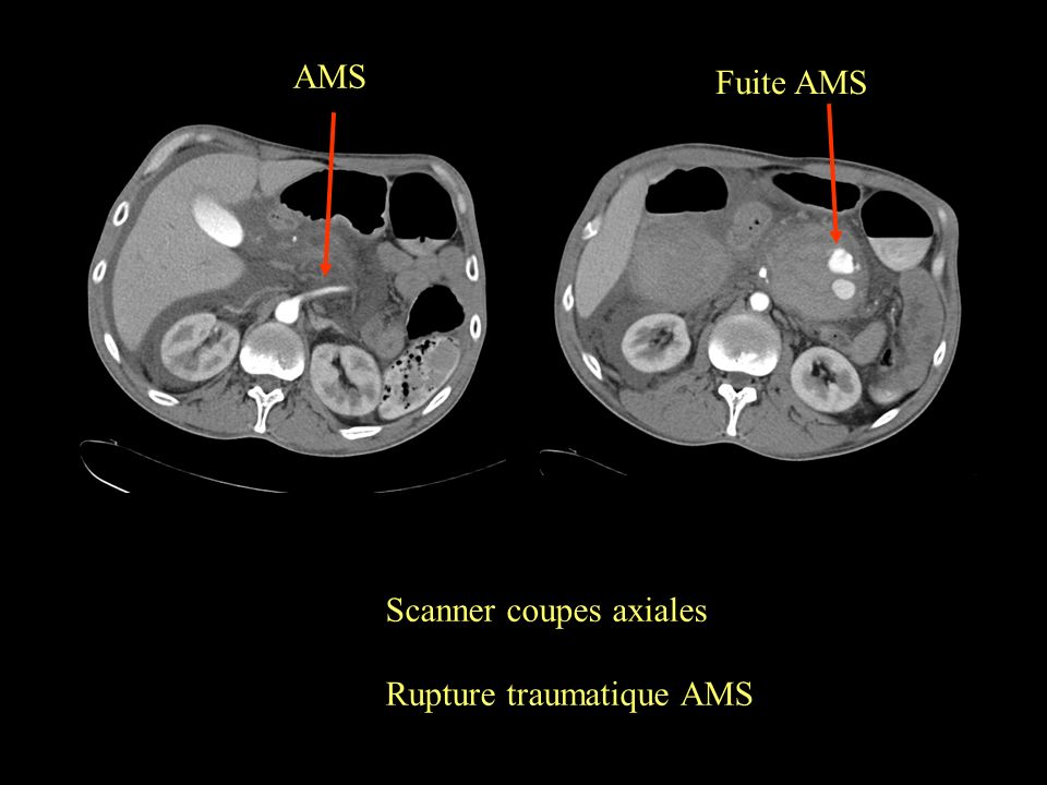 AMS Fuite AMS Scanner coupes axiales Rupture traumatique AMS