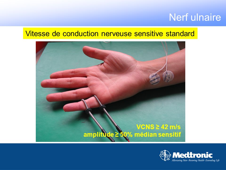 Nerf ulnaire Vitesse de conduction nerveuse sensitive standard