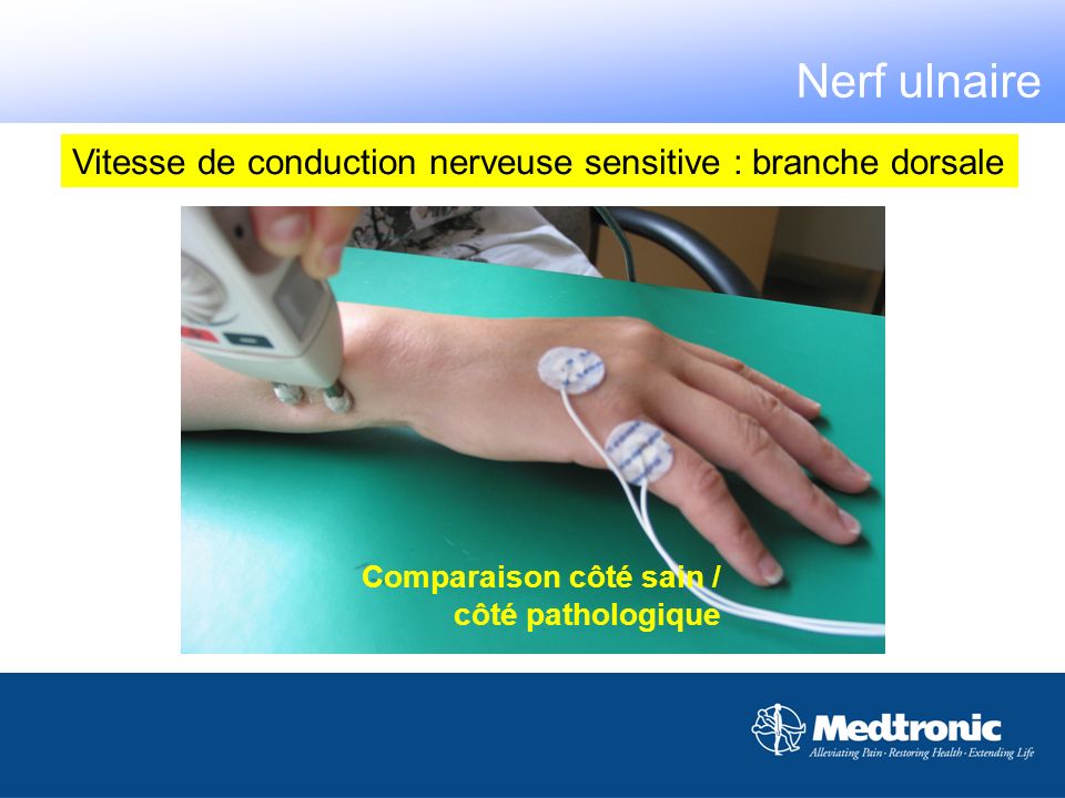Nerf ulnaire Vitesse de conduction nerveuse sensitive : branche dorsale.