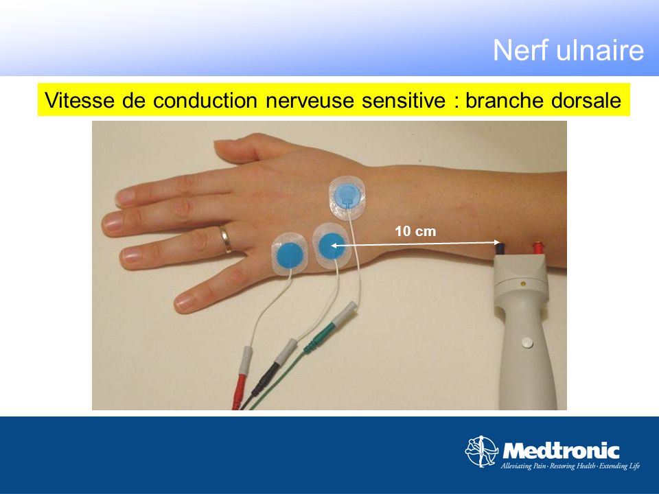 Nerf ulnaire Vitesse de conduction nerveuse sensitive : branche dorsale 10 cm