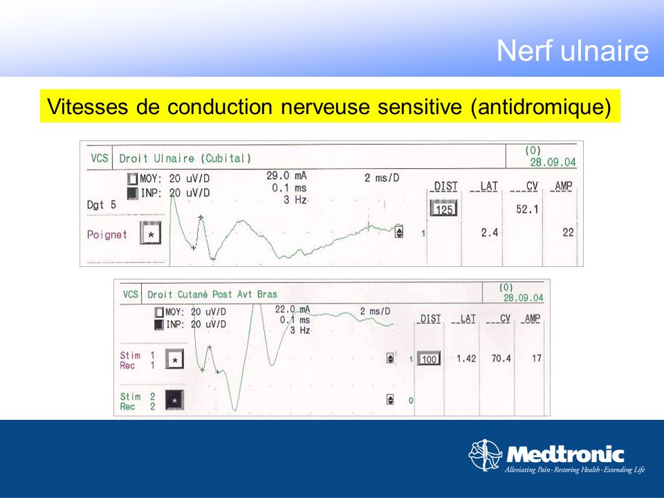 Nerf ulnaire Vitesses de conduction nerveuse sensitive (antidromique)