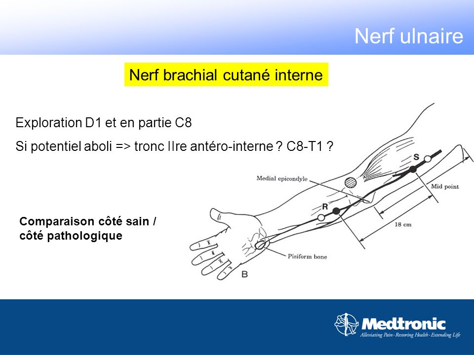 Nerf ulnaire Nerf brachial cutané interne
