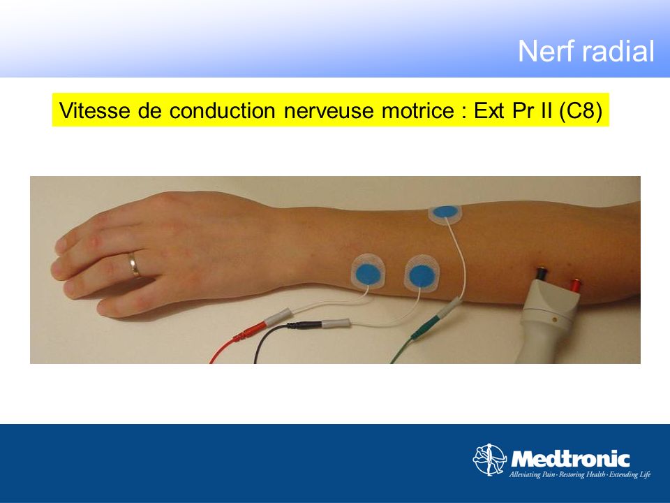 Nerf radial Vitesse de conduction nerveuse motrice : Ext Pr II (C8)