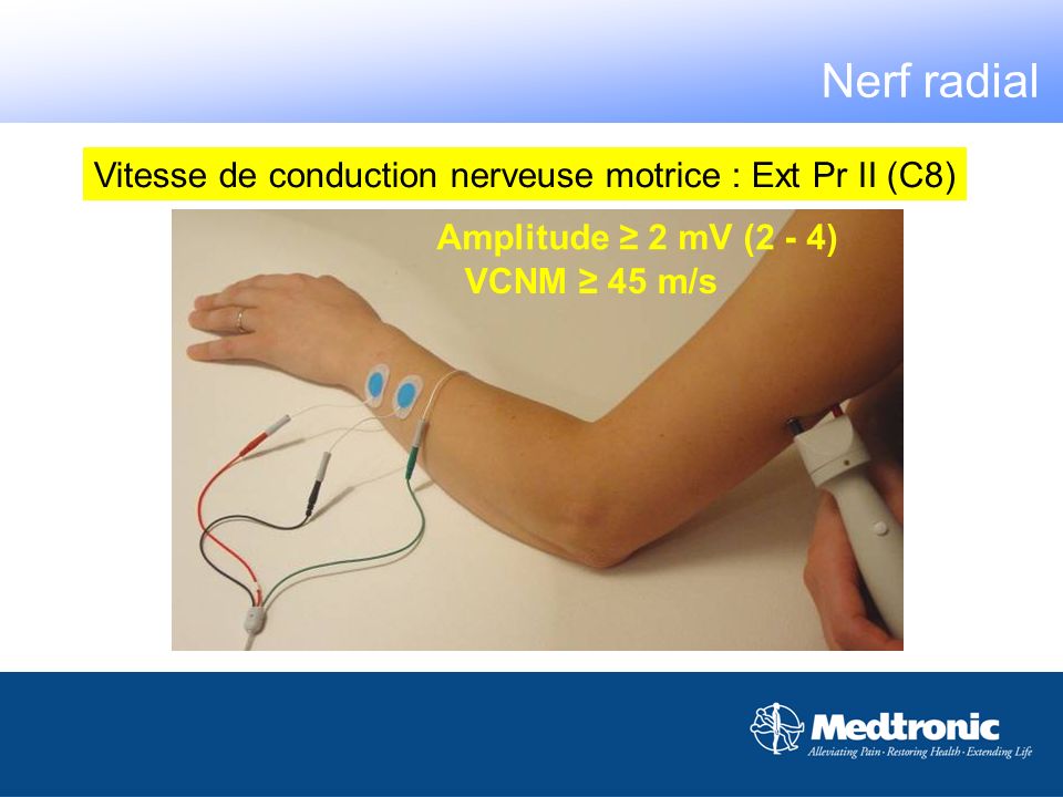 Nerf radial Vitesse de conduction nerveuse motrice : Ext Pr II (C8)