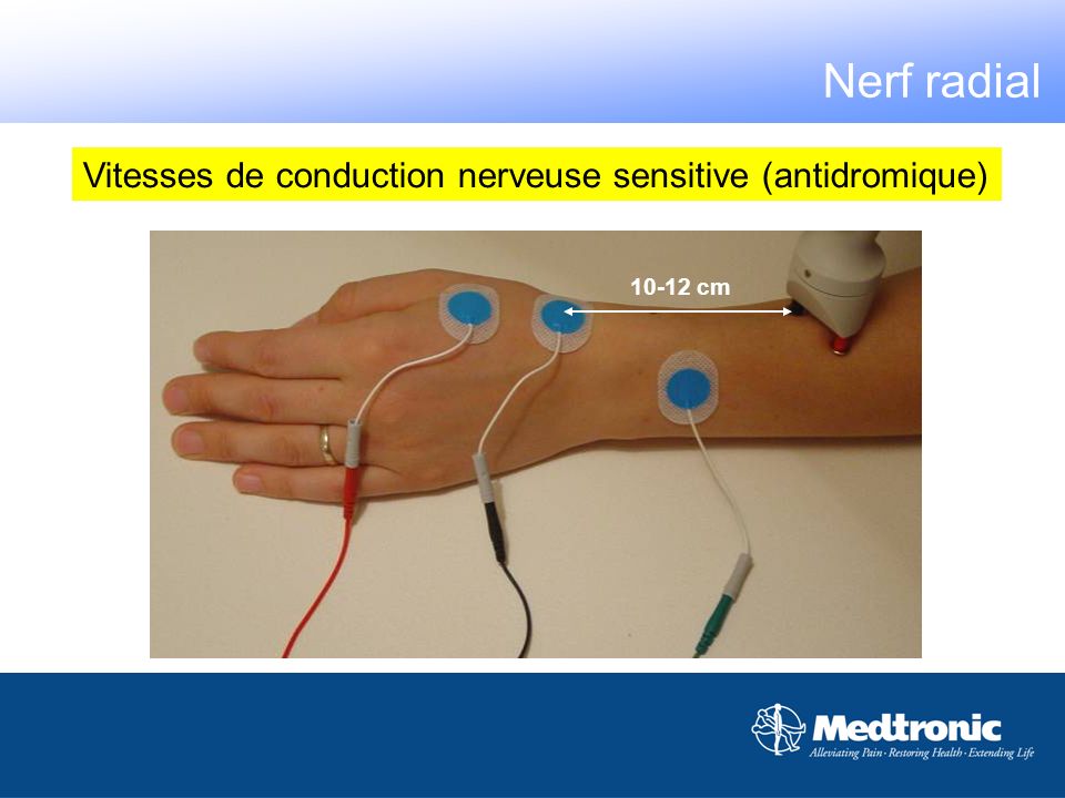 Nerf radial Vitesses de conduction nerveuse sensitive (antidromique)