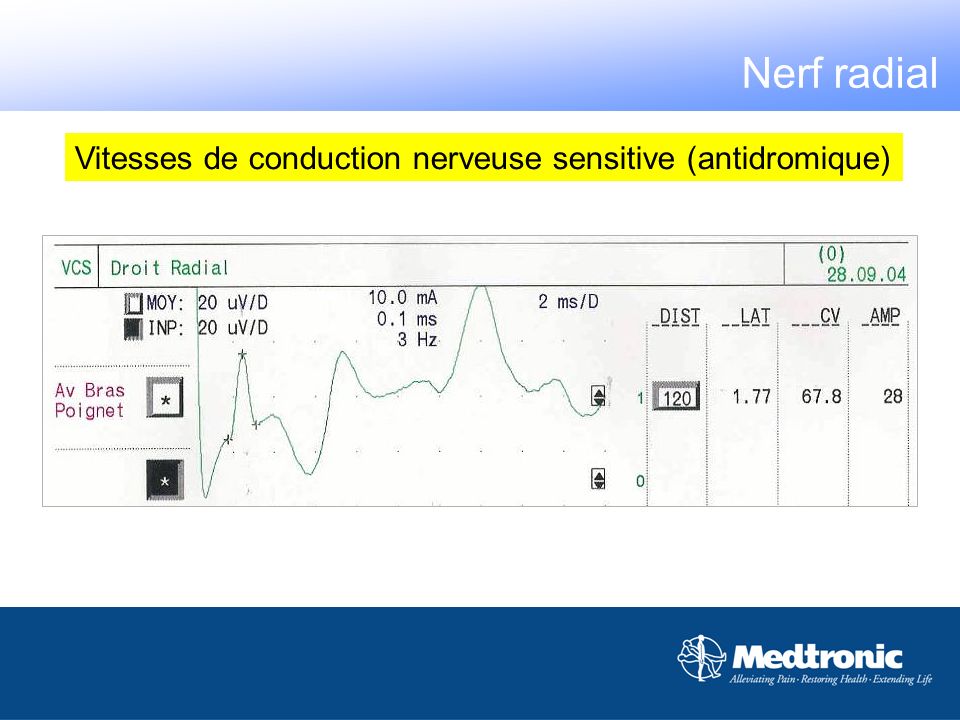 Nerf radial Vitesses de conduction nerveuse sensitive (antidromique)