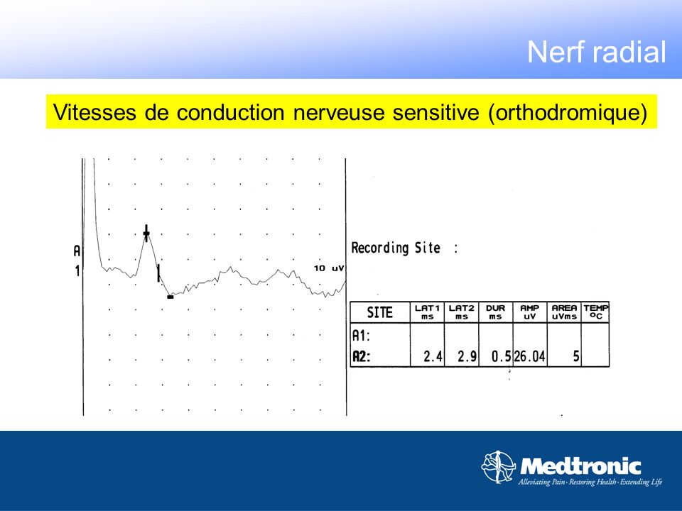 Nerf radial Vitesses de conduction nerveuse sensitive (orthodromique)