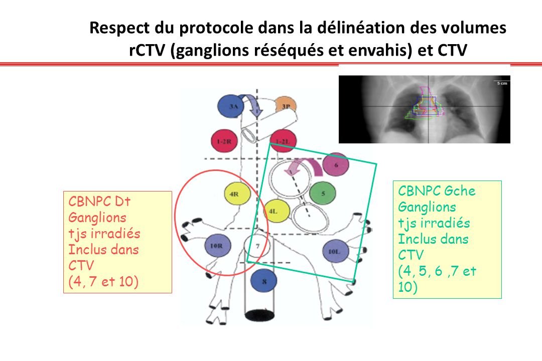 Respect du protocole dans la délinéation des volumes rCTV (ganglions réséqués et envahis) et CTV