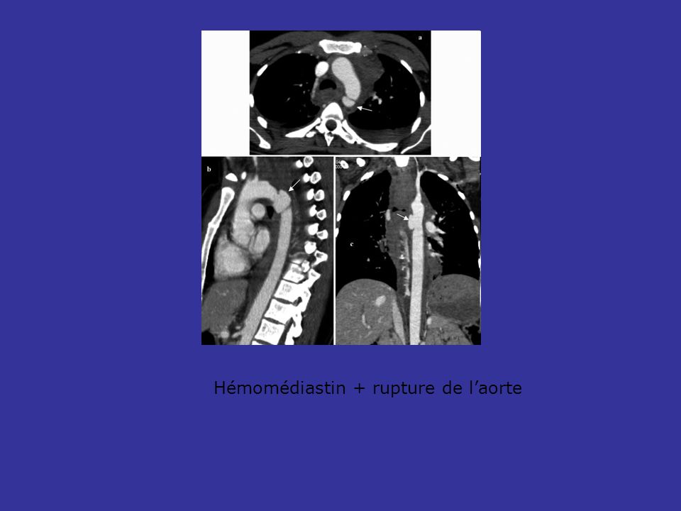 Hémomédiastin + rupture de l’aorte