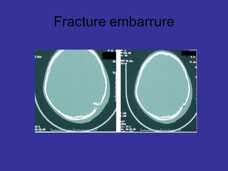 Fracture embarrure