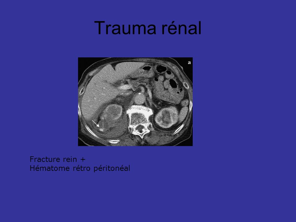 Trauma rénal Fracture rein + Hématome rétro péritonéal