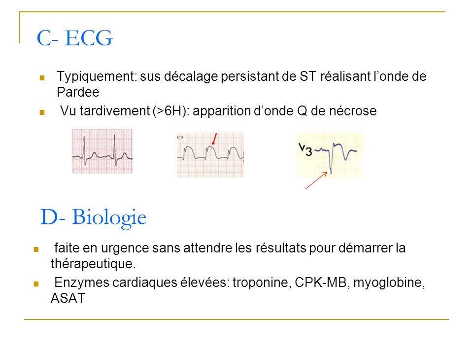 C- ECG Typiquement: sus décalage persistant de ST réalisant l’onde de Pardee. Vu tardivement (>6H): apparition d’onde Q de nécrose.