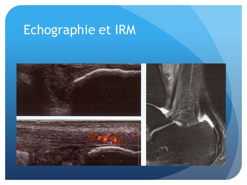 Echographie et IRM