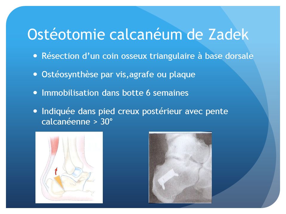Ostéotomie calcanéum de Zadek