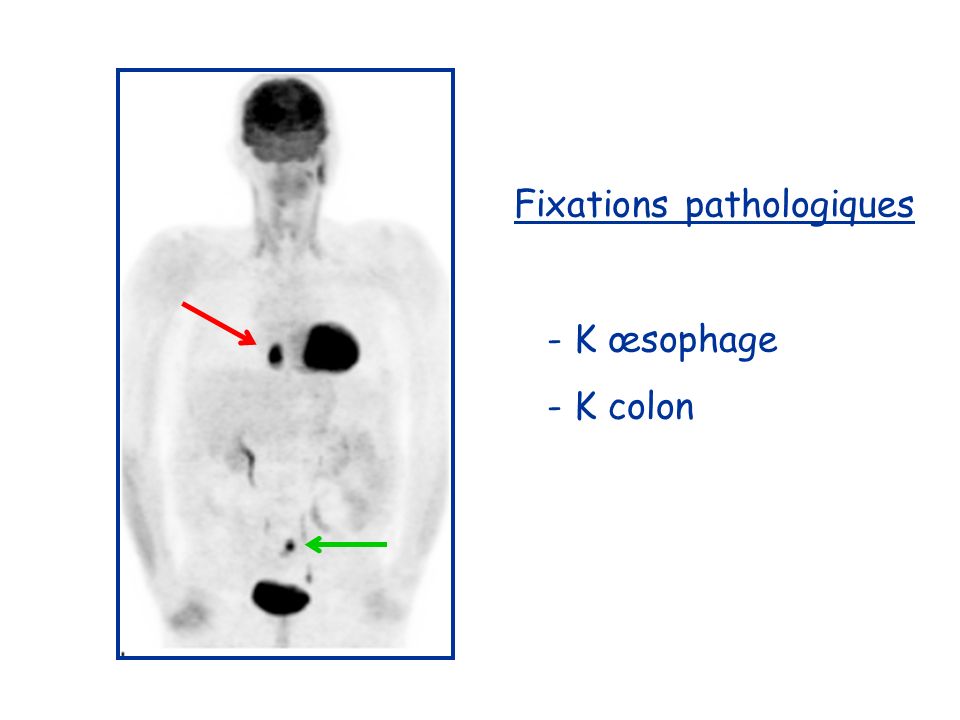 Fixations pathologiques - K œsophage - K colon