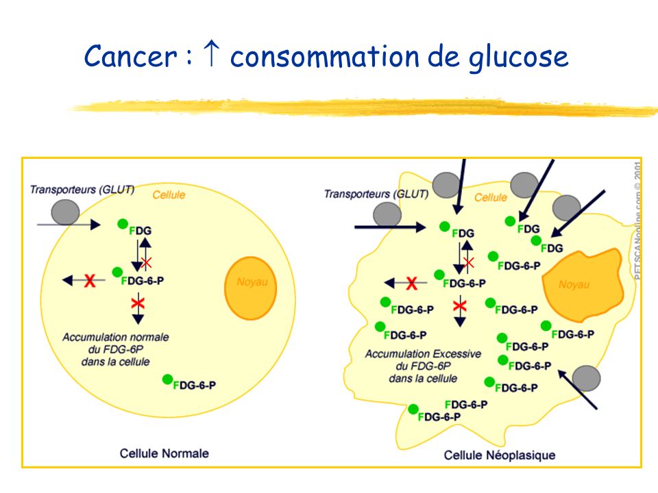 Cancer :  consommation de glucose