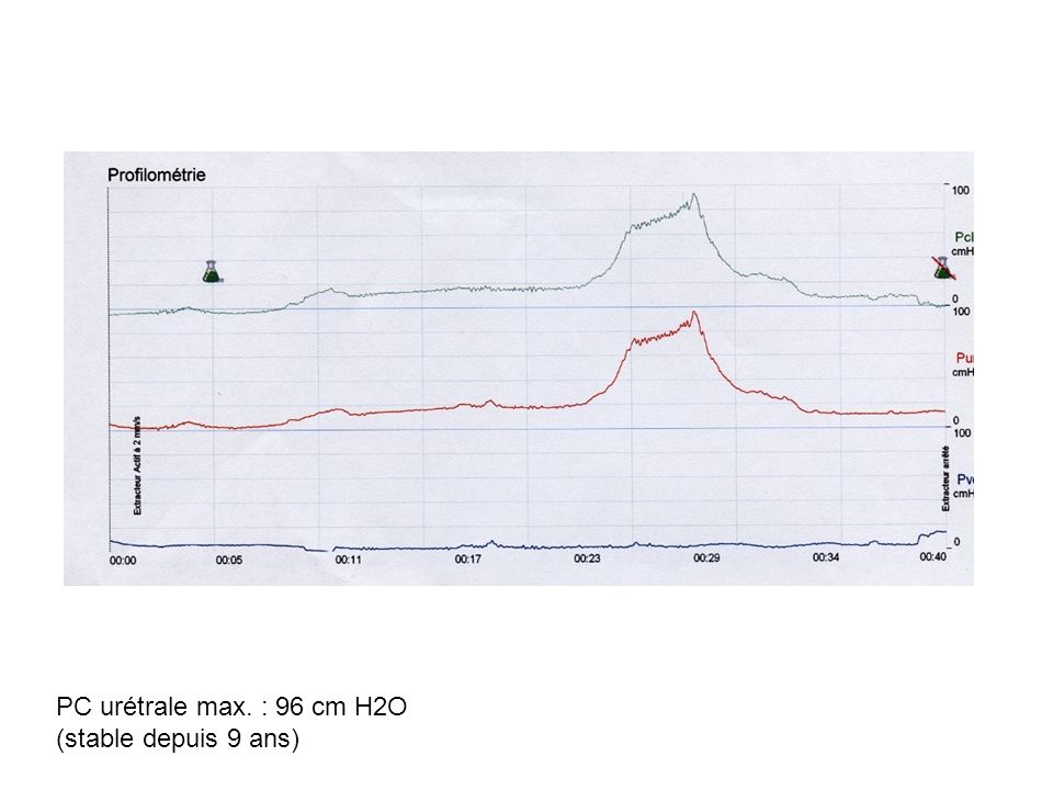 PC urétrale max. : 96 cm H2O (stable depuis 9 ans)