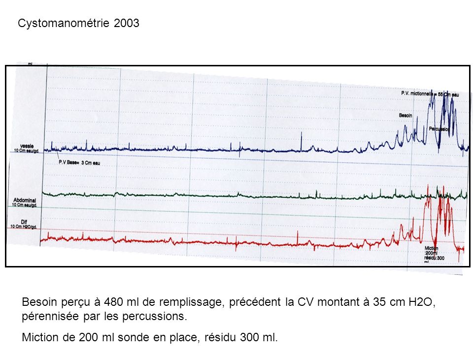 Cystomanométrie 2003 Besoin perçu à 480 ml de remplissage, précédent la CV montant à 35 cm H2O, pérennisée par les percussions.