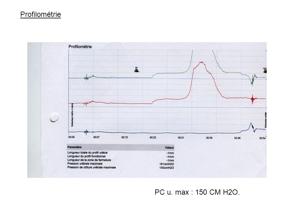 Profilométrie PC u. max : 150 CM H2O.
