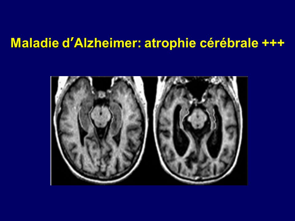 Maladie d’Alzheimer: atrophie cérébrale +++